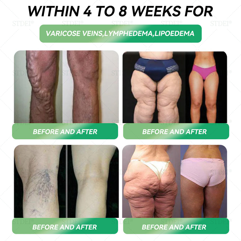 Recommended by leading U.K. clinics | Official Store | ๐บ๐ป๐ซ๐ธ๐ผยฎ ๐ฎ๐ณ๐ท-1 ๐๐๐๐ ๐๐๐๐ข๐ก๐๐๐ ๐ฑ Only once a week, visible results within 7 days (Targeting ๐๐๐๐ ๐๐ก๐ฆ, ๐๐ฆ๐๐โ๐๐๐๐๐, ๐๐๐๐๐๐ก๐๐ , ๐๐๐ โ๐๐๐๐ก-๐๐๐๐๐ก๐๐ ๐๐๐๐๐๐ก๐๐๐๐ ) ๐น