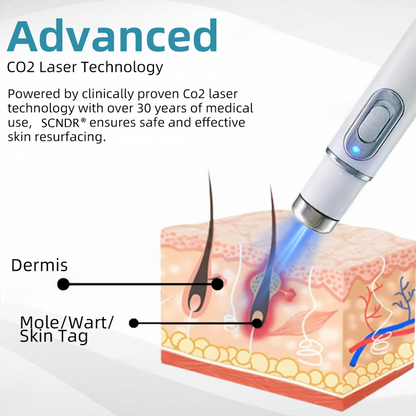 SCNDR® Non-Invasive Mole and Wart Removal Laser Pen🥝